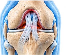 ACL & Ligament Repair