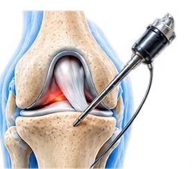 Arthroscopy